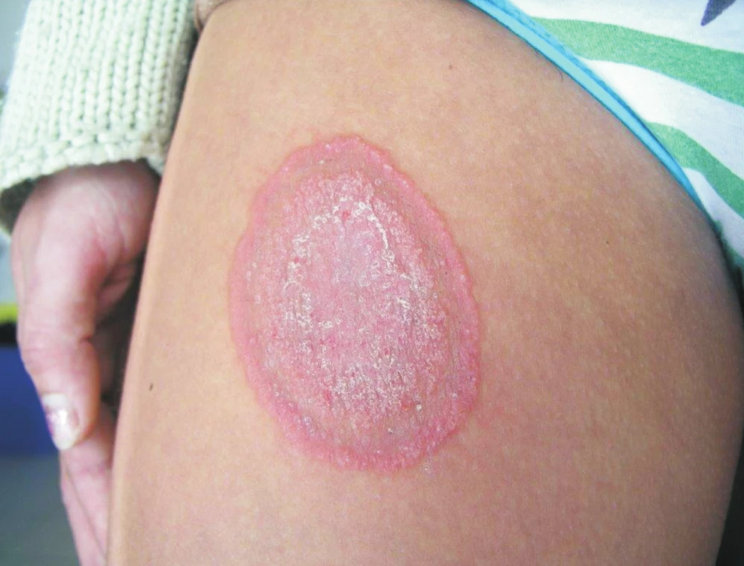 Tinea corporis způsobená <i>A. benhamiae</i> u mladé ženy