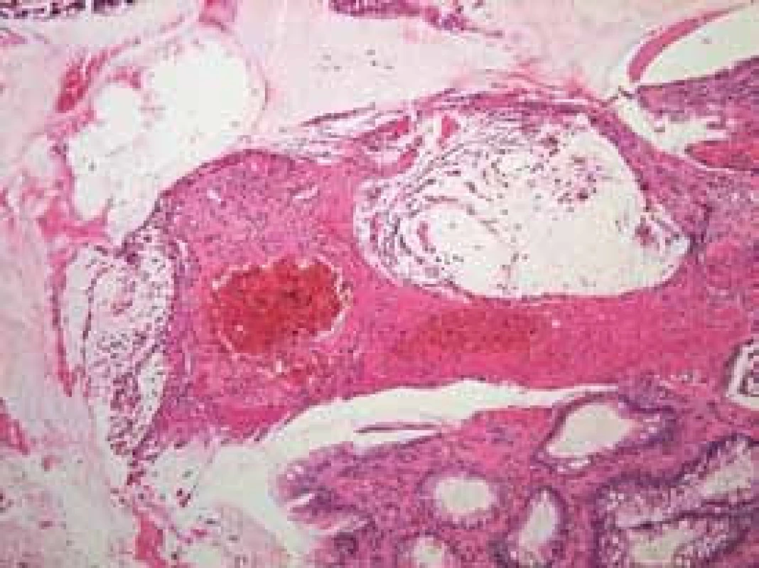 Histologické vyšetření před léčbou zachycuje vředovitý defekt s fibrinem a polymorfonukleáry na spodině, sliznice v okolí vykazuje reaktivní nepravidelnosti.
Fig. 2. Histology specimen before the therapy proved the ulceration covered by fibrin and polymorphonuclear cells, surroundig mucosa shows a reactive irregularities.