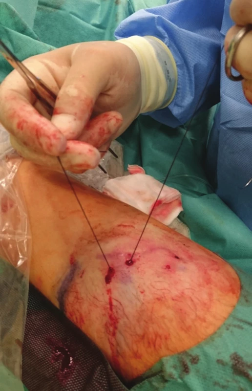 Provlečení nitě pod žilou
Fig. 2: The suture is drawn under the vein