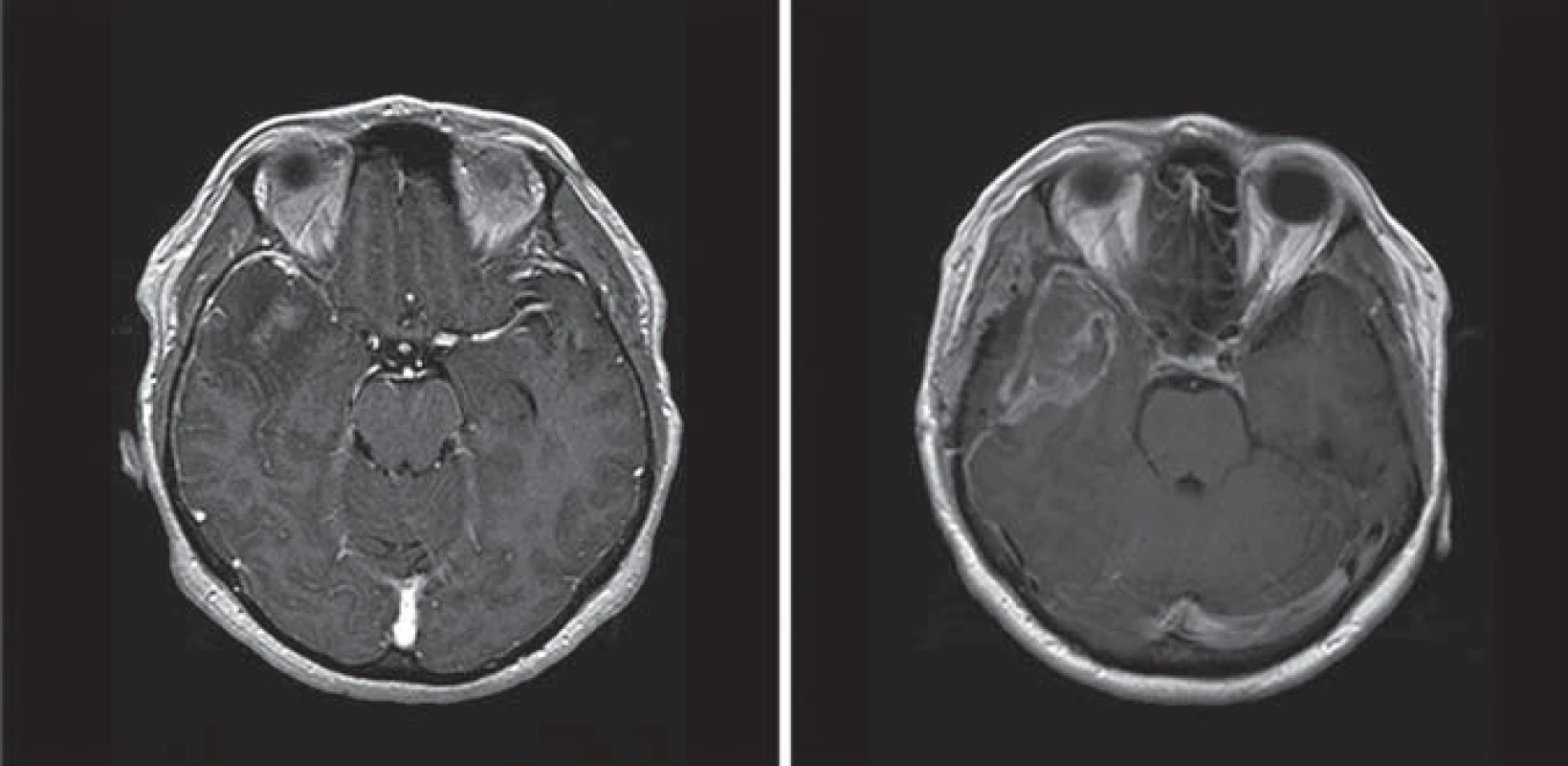 MR obraz pacienta s glioblastoma multiforme.

