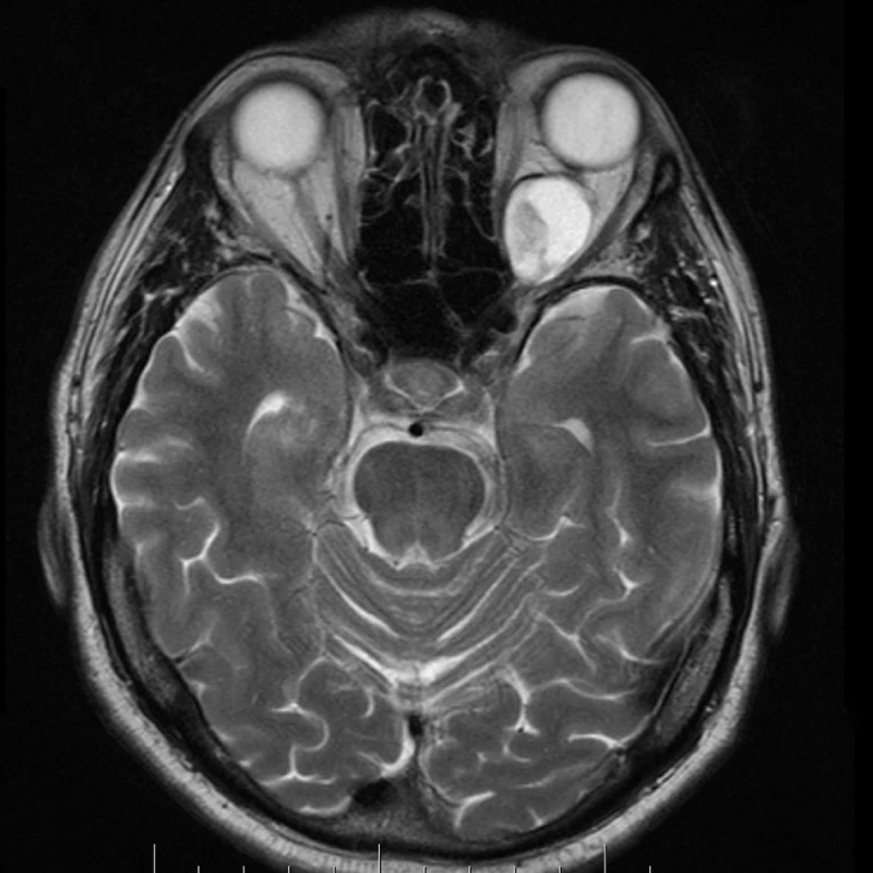 MR, axiální řez – intrakonálni, ostře ohraničený tumor převážně cystického charakteru s menší solidní porcí mediálně, velikosti 27x20x18mm, vyplňující vnitřní polovinu levé orbity retrobulbárně s elevací a laterální dislokací optického nervu a roztlačující okohybné svaly do stran