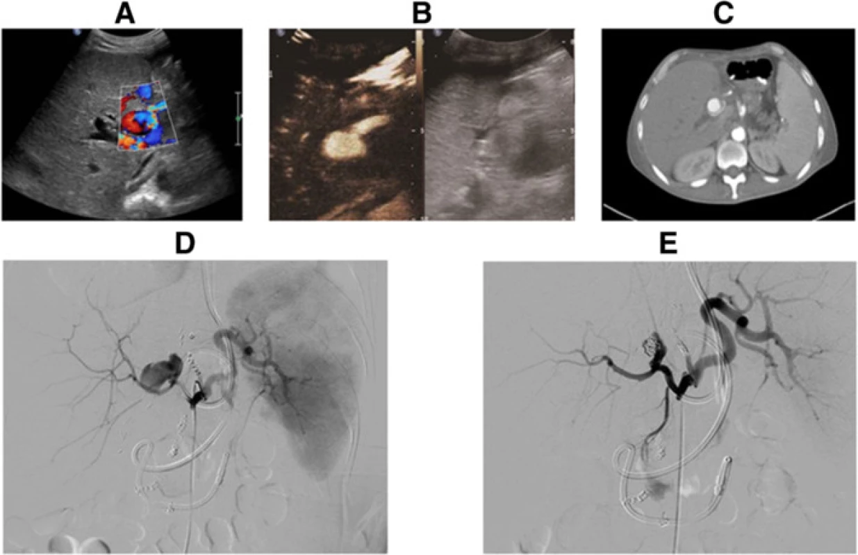 HAP was identified by (a) Color Doppler ultrasound, b CEUS and c Contrast-enhanced CT (<i>arrow</i>), and confirmed by (d) DSA. e The patient underwent coil embolization combined with thrombin injections, and the lumen of the pseudoaneurysm was totally occluded, which was confirmed by DSA
