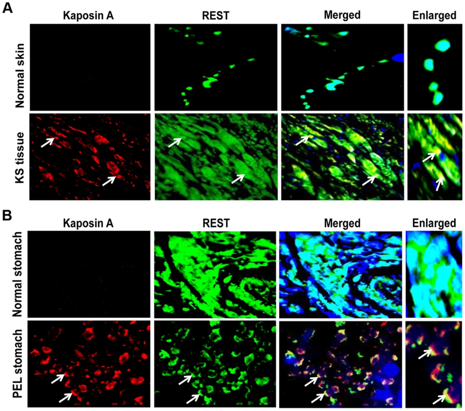 Colocalization of REST and Kaposin in KSHV-infected patient samples.