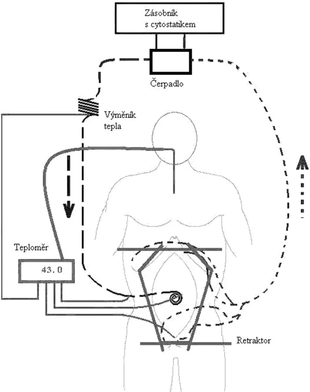 Schéma hypertermické intraoperační terapie, upraveno podle [10]