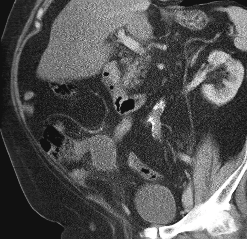 CT vyšetření břicha při příjmu
Fig. 1. Abdominal CT examination on admission