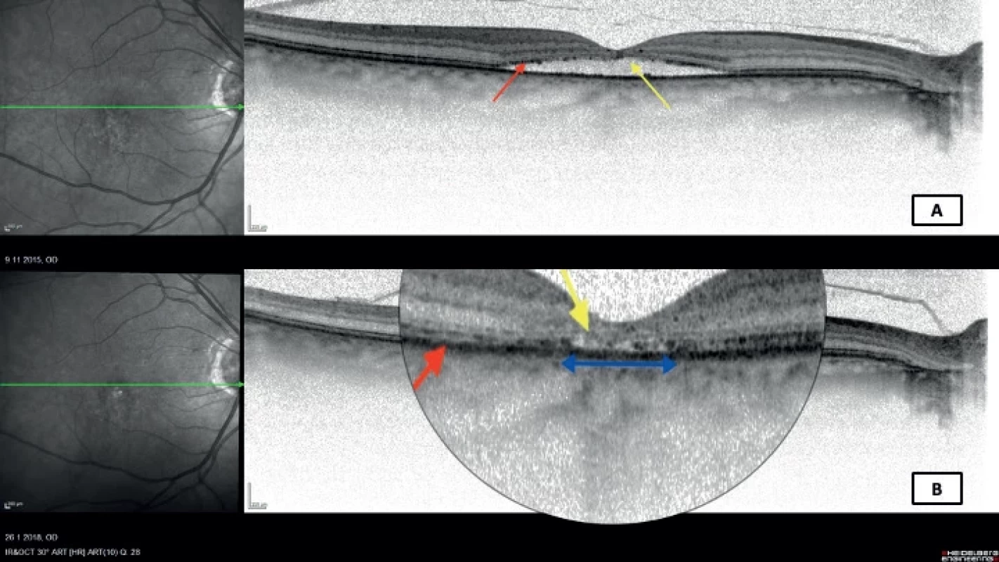 Transfoveolar linear optical coherence tomography scan (Heidelberg Spectralis, Myslík Manethová) of a 61-year-old patient with chronic central serous chorioretinopathy showing: