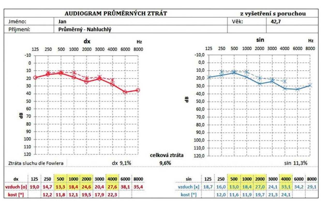 Audiogram průměrných ztrát na jednotlivých frekvencích.