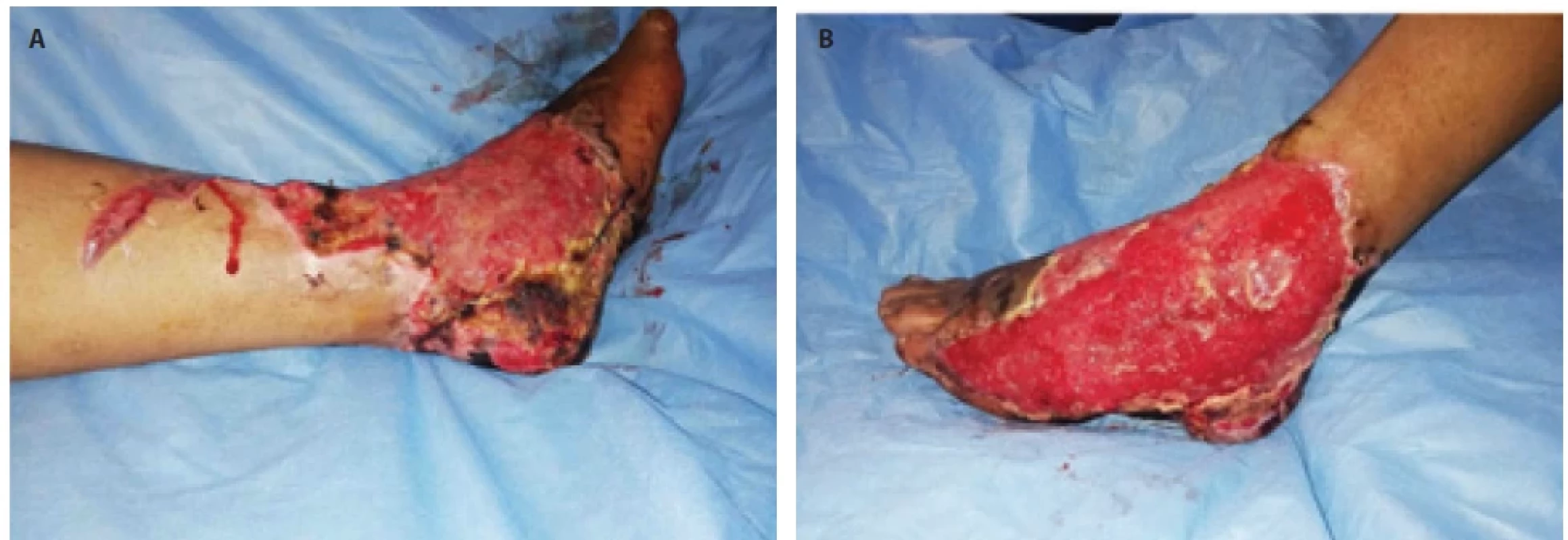 Dorsal and plantar components of raw area.