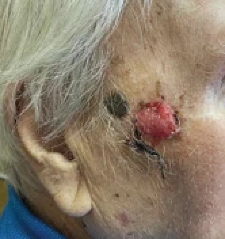 Exulcerated basal cell carcinoma of the temple.
