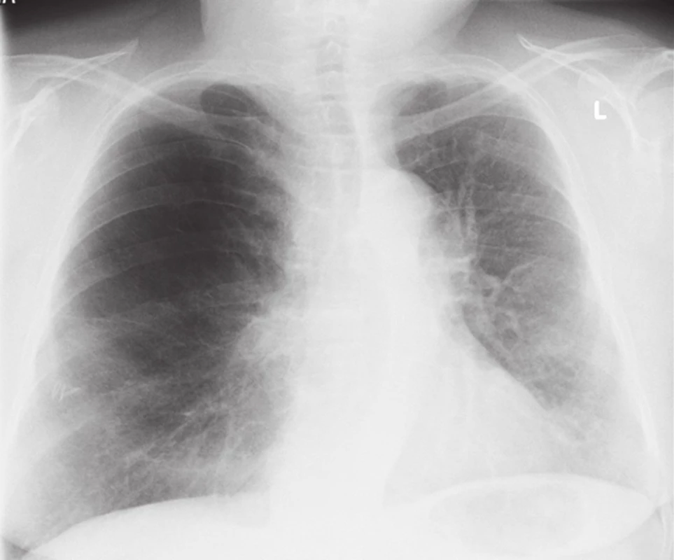 RTG po primotransplantaci
Fig. 1. Chest X-ray after primary transplantation