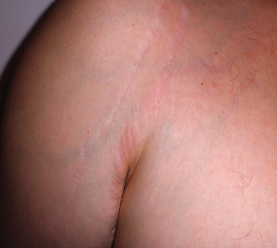 Atrofické strie v atypickej lokalizácii.
Fig. 5. Atrophic striae in atypical locations.
