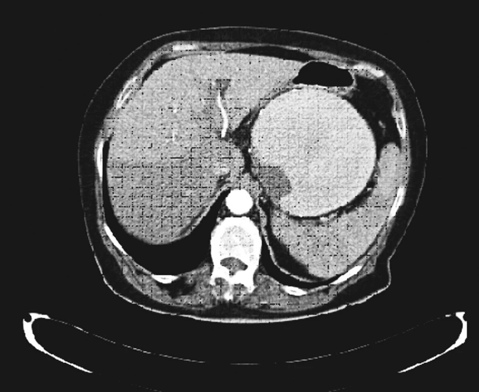 Obrovské aneuryzma lienální tepny (CT AG)
Fig. 1. A massive aneurysm of the lienal artery (CT AG)
