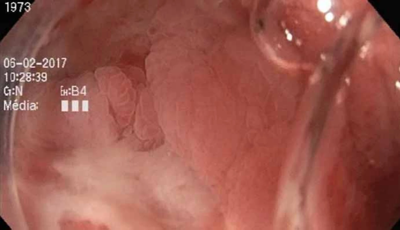 Neoterminální ileum s klidovým nálezem po 5měsíní léčbě vedolizumabem.
Fig. 6. Healed neoterminal ileum with finding after 5 months of treatment with vedolizumab.