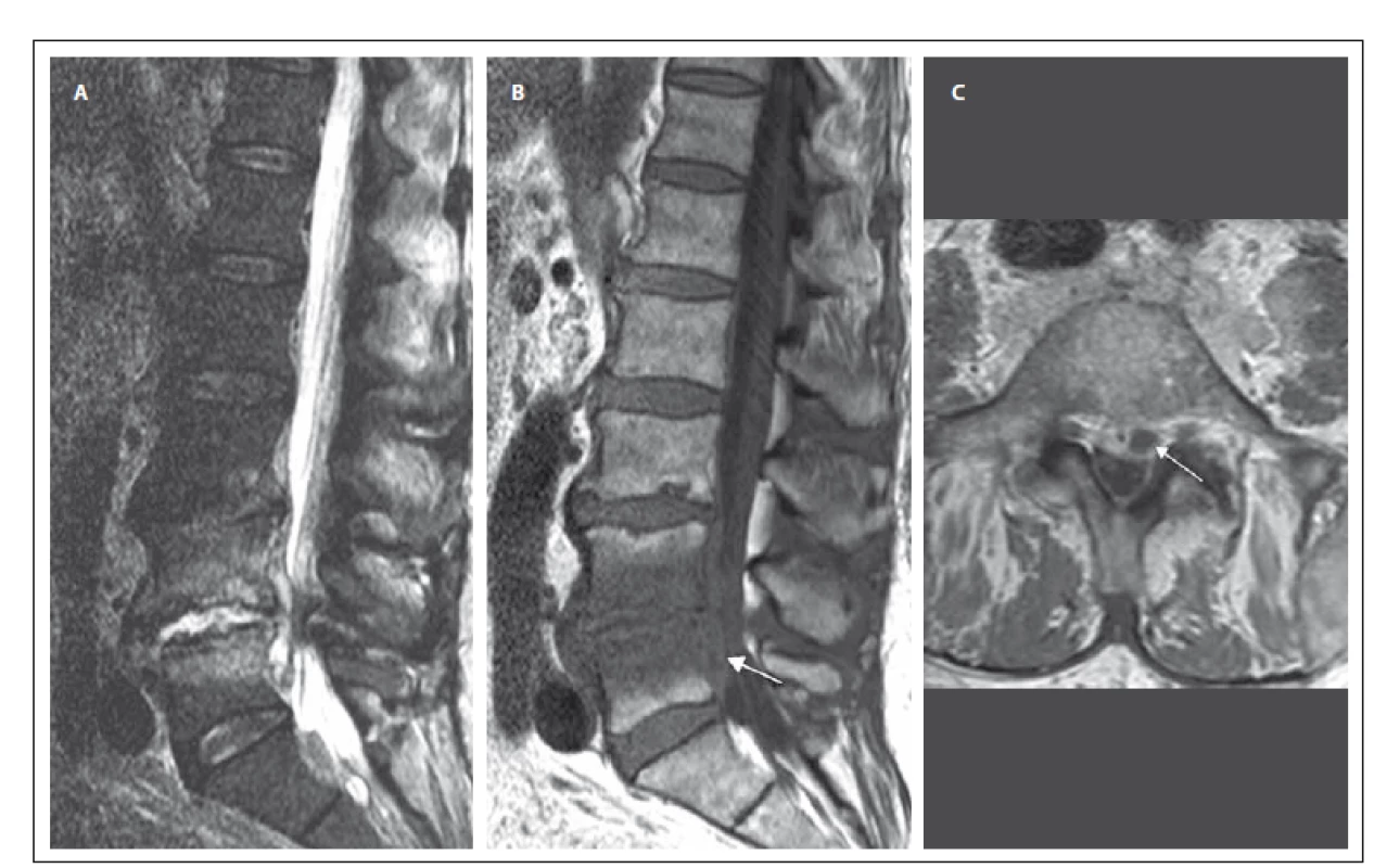 MR vyšetření bederní páteře u pacienta se spondylodiscitidou v etáži L 4/5 (pacient č. 2).
Obr. 1A) STIR sekvence, sagitální rovina. Obrázek ukazuje hyperintenzní meziobratlovou ploténku L4/5, nerovnosti krycích ploten a abnormální
hyperintenzitu – edém obratlových těl L4 a L5 v návaznosti na meziobratlový prostor.
Obr. 1B) T1 vážený obraz, sagitální rovina. Snížený signál obratlových těl koresponduje s edémem sledovatelným v sekvenci STIR. Patologicky zvýšený signál ve ventrálním epidurálním prostoru – absces (šipka).
Obr. 1C) T1 vážený obraz, postkontrastně, axiální rovina. Patologické sycení při obvodu intervertebrálního disku L4/5, epidurálního prostoru a přilehlých obratlových těl s usuracemi krycích ploten. Abscesová kolekce za tělem L5 paramediálně vlevo šíře až 10 mm (šipka).
Fig. 1. MRI examination of the lumbar spine in a patient with spondylodiscitis at the L4/5 level (patient No. 2).
Obr. 1A) STIR sequence, sagittal orientation. Image reveals a markedly hyperintense intervertebral disc L4/5, irregularities of the endplates and abnormal hyperintensity – edema of vertebral bodies L4 and L5 contiguous with the intervertebral space.
Obr. 1B) T1-weighted image, sagittal orientation. The marked hypointensity of the vertebral bodies corresponds with edema fi nding in the STIR sequence. The pathological increase of the signal in ventral epidural space – abscess (arrow).
Obr. 1C) Contrast-enhanced T1-weighted image, axial orientation. Peripheral pathological enhancement of the intervertebral disc L4/5, enhancement of epidural space and adjacent vertebral