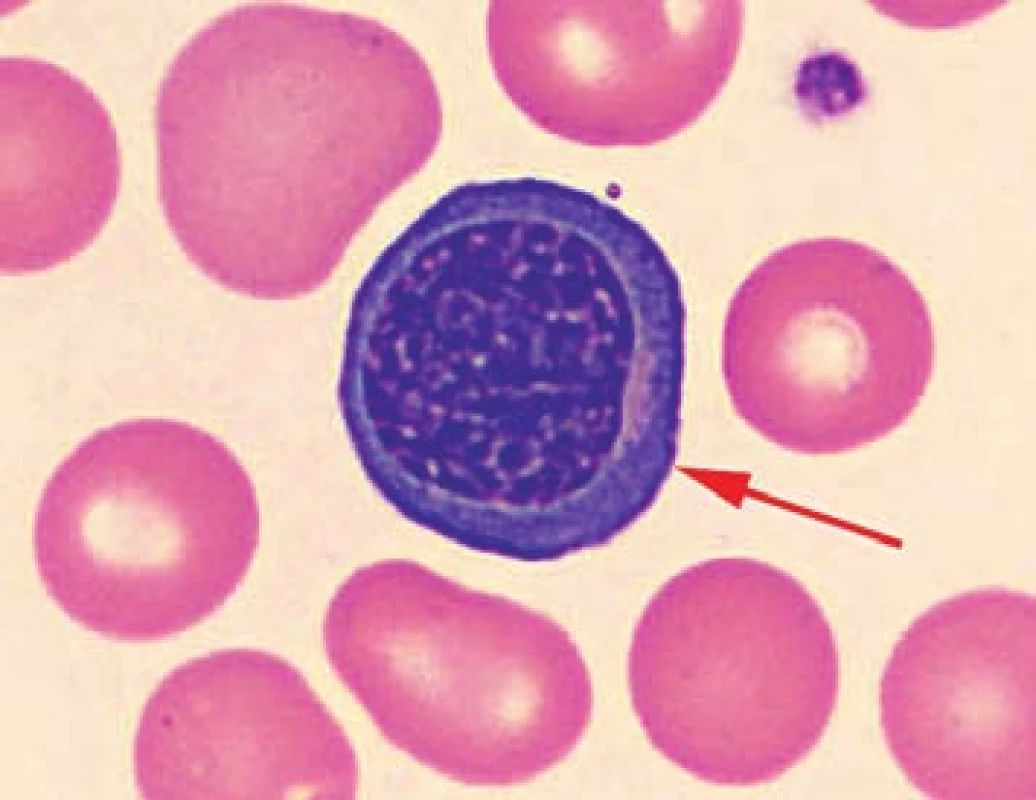 Detail nátěru periferní krve pacienta č. 3 s nálezem jaderné erytroidní buňky.
Fig. 3. Detail of the patient’s peripheral blood smear No. 3 with finding of nucleated erythroid cells.