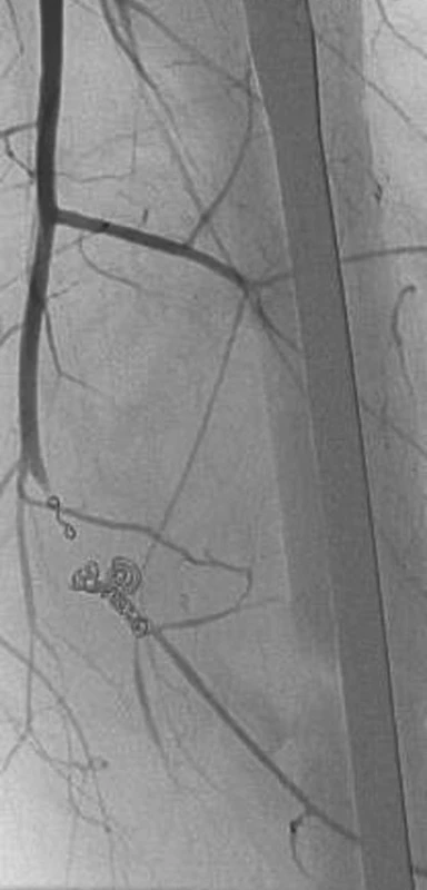 5. Angiografický obraz zavedených spirál do oblasti pseudoaneuryzmatu
Pic. 5. Angiographic view of spirals introduced into the pseudoaneurysmal region