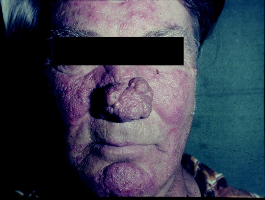 Rhinophyma.