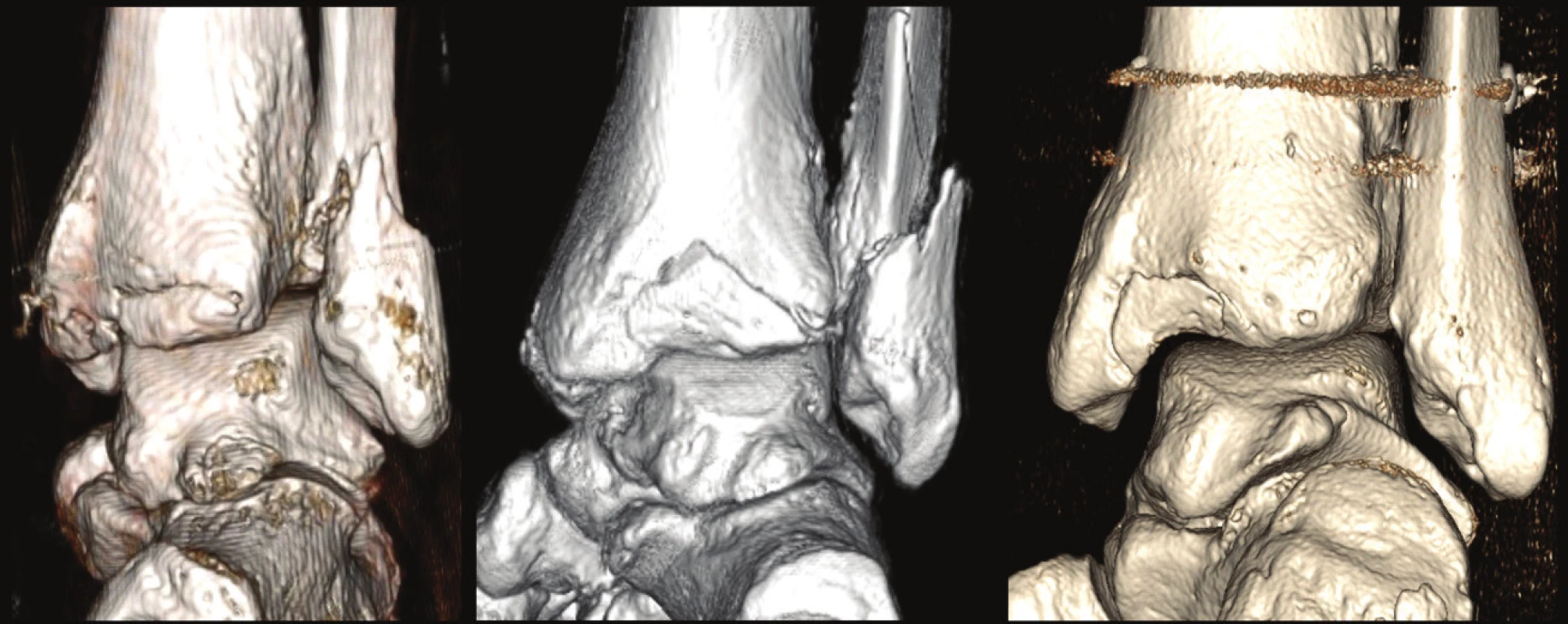 Variabilita typu 1 (extraincisurální fragment) na 3D CT rekonstrukcích
a – fragment je tvořen pouze tuberculum posterius tibiae, b – fragment je tvořen tuberculum posterius tibiae a přilehlou částí zadní hrany tibie, c – fragment je tvořen mediální částí zadní hrany tibie a zasahuje do sulcus malleolaris.
Fig. 11: Variability of type 1 (extraincisural fragment) on 3D CT reconstructions
a – fragment is formed only by tuberculum posterius tibiae, b - fragment is formed by tuberculum posterius tibiae and the adjacent posterior tibial edge, c – fragment is formed by the medial part of posterior tibial edge with involvement of the malleolar groove.