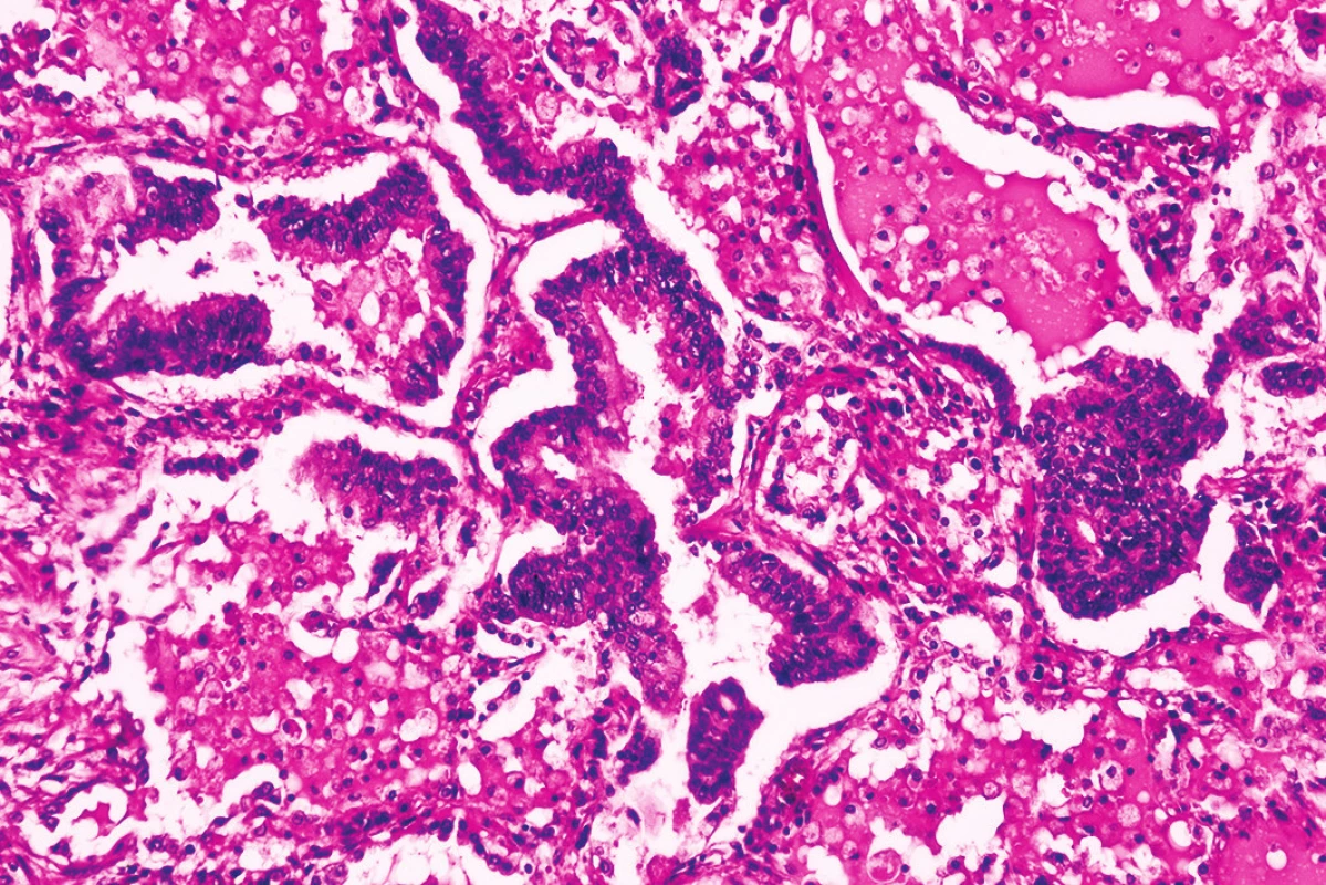 Hyperregenerácia pneumocytov (hematoxylín-eozín, zväčšenie 100x).
