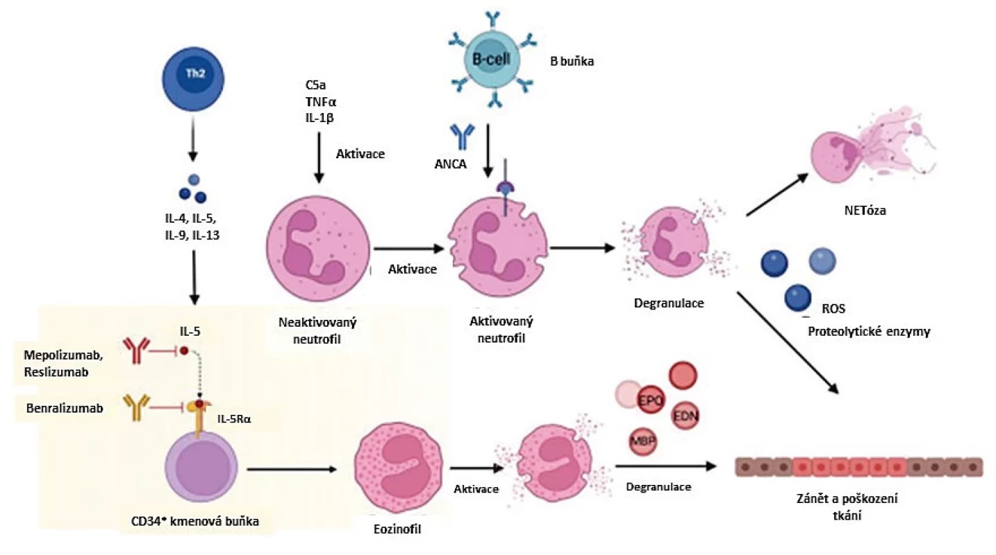 Hlavní patogenní dráhy u eozinofilní granulomatózy s polyangiitidou (EGPA): ANCA indukovaný cévní zánět a eozinofily v mechanismu zánětlivého poškození tkání vč. blokace na úrovni IL-5 (upraveno podle 9)