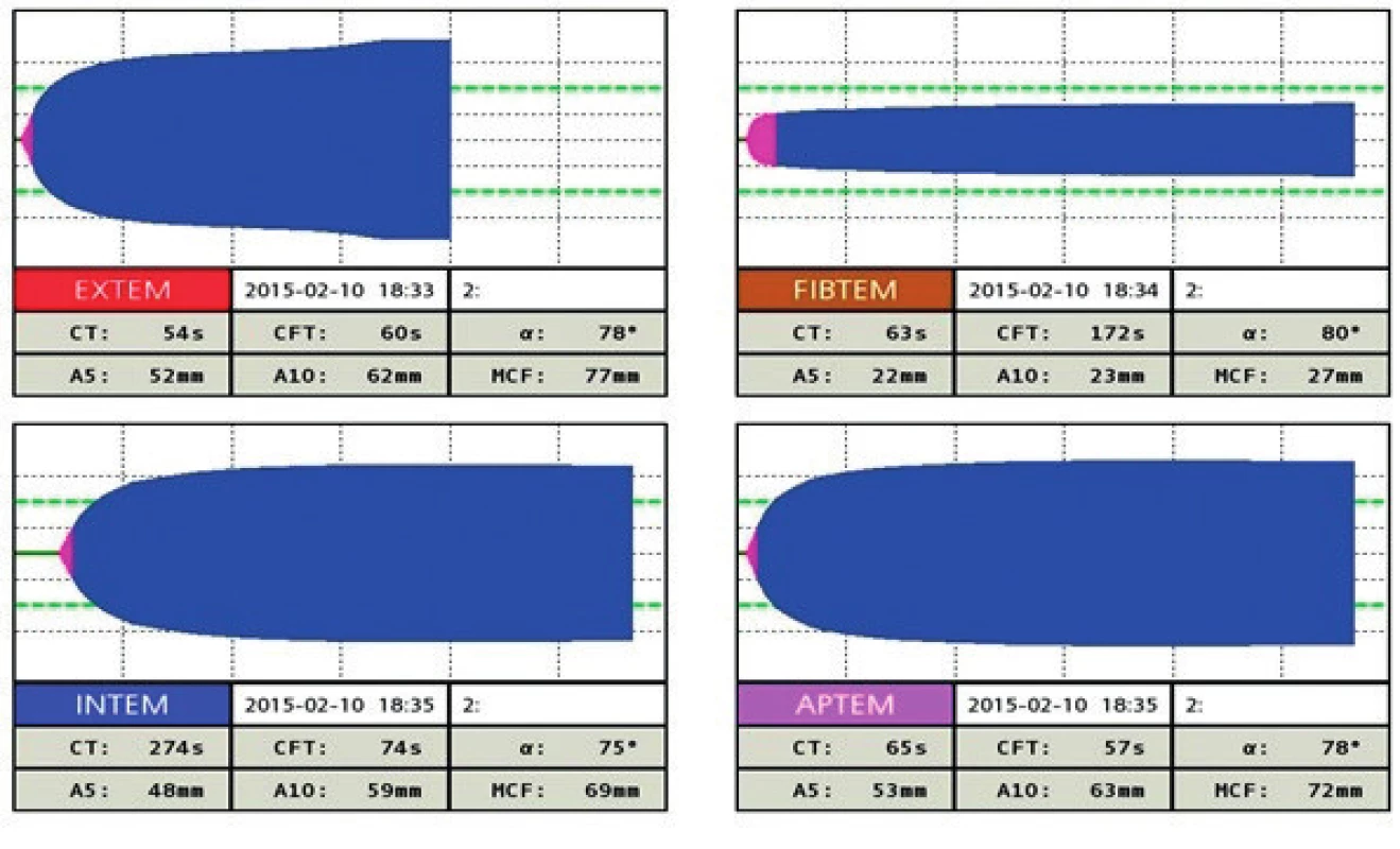 Trombelastogram, vyšetření po terapii, normalizace křivky
V kanálu FIBTEM i v ostatních kanálech je větší robustnost ve srovnání s předchozím vyšetřením – tedy normalizace koagulace ve všech jejích složkách.