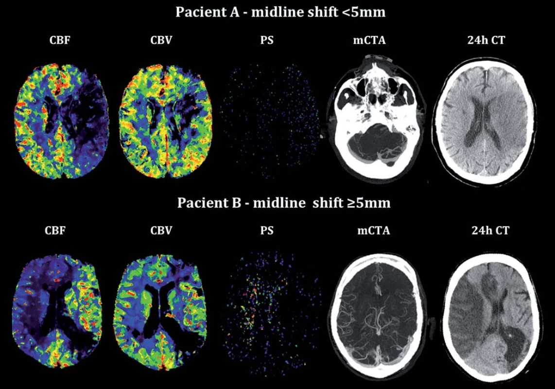 Vstupní analýza CT perfuze, multifázická CTA a kontrolní CT mozku u pacienta bez a s rozvojem posunu středočárových struktur (midline shift).
Fig. 2. Admission CT perfusion analysis, multiphase CTA and control brain CT in patient without and with signifi cant midline shift.