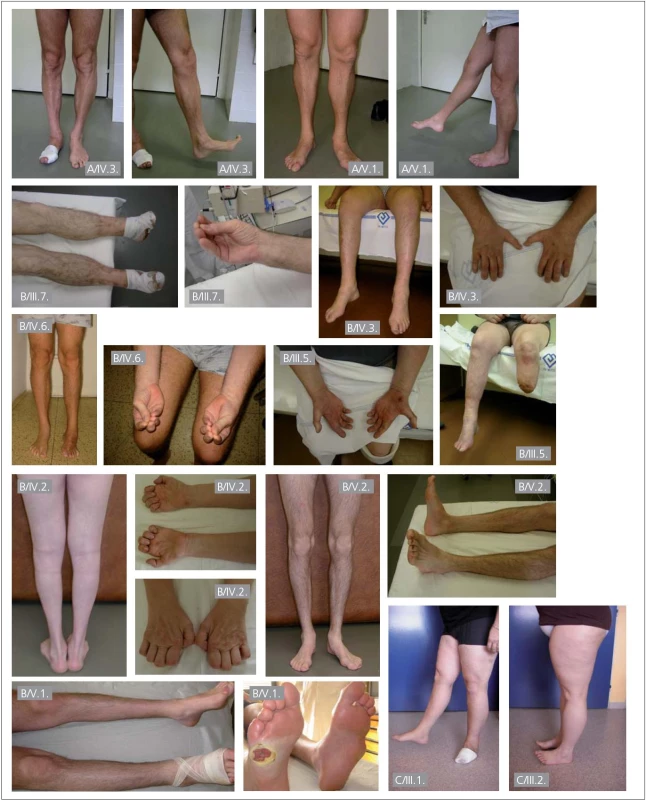 Fotografie pacientů s dědičnou senzitivní neuropatií.