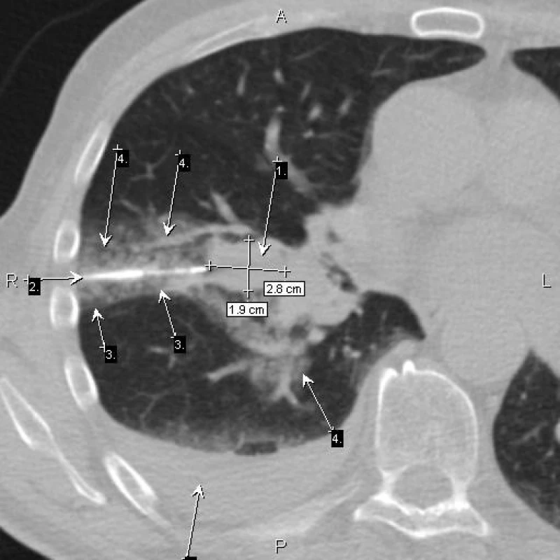 Centrálně při hilu ložisko (šipka 1), bioptická jehla (šipka 2)
Průběh hlavního interlobia (šipky 3), který ohraničil okrsky plicní hemoragie (šipky 4). Melanom.