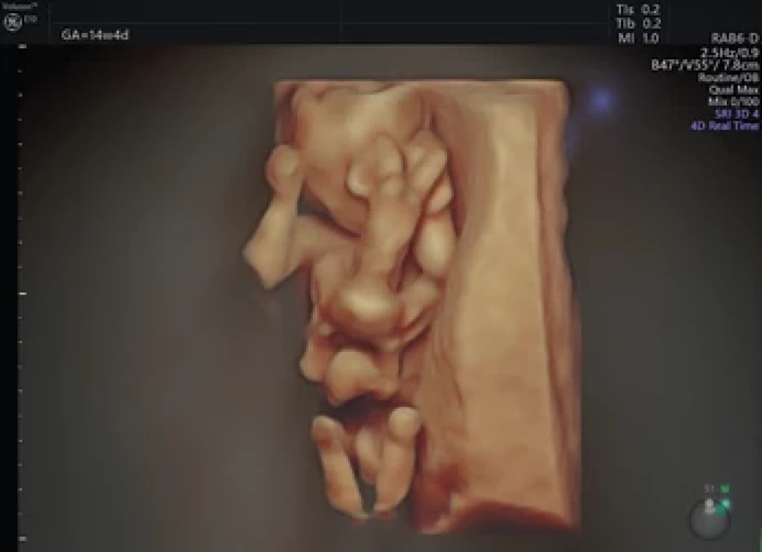 High-defi nition three-dimensional ultrasound image at 14th weeks of gestation showing parasitic conjoined twins (omphalopagus), with the extrafetal body (parasite) attached above the umbilical cord insertion, displaying an omphalocele of the autosite.