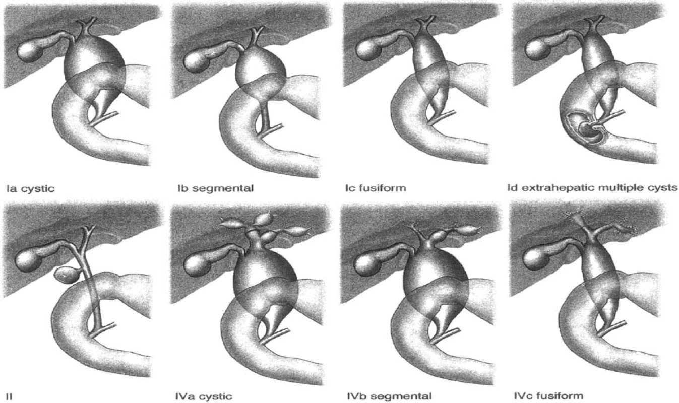 Modifikovaná Todaniho klasifikácia cyst choledochu [8]
Pic. 7. Modified Todani classification of choledochal cysts [8]
