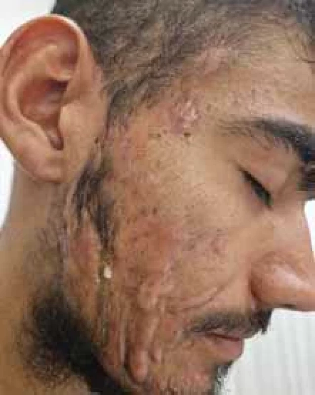 Acne conglobata.