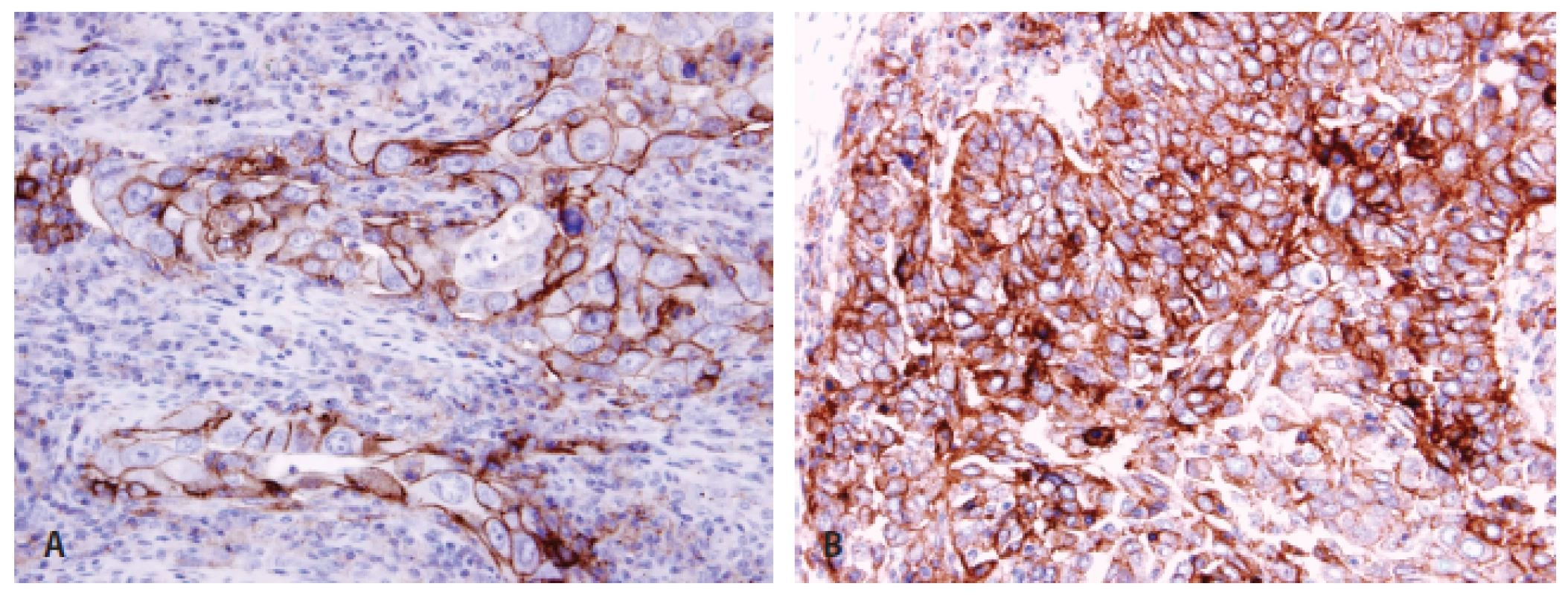 Pozitivita PD-L1 u plicního adenokarcinomu <b>(A)</b> a dlaždicobuněčného karcinomu <b>(B)</b> imunohistochemicky protilátkou klonu 22C3.