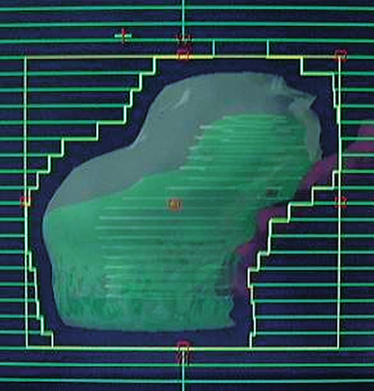 Tvarované pole využívané v konformní radioterapie, pohled ze svazku záření (BEV)
Fig. 1. Shaped field used in conformal radiotherapy, beams eye view (BEV)