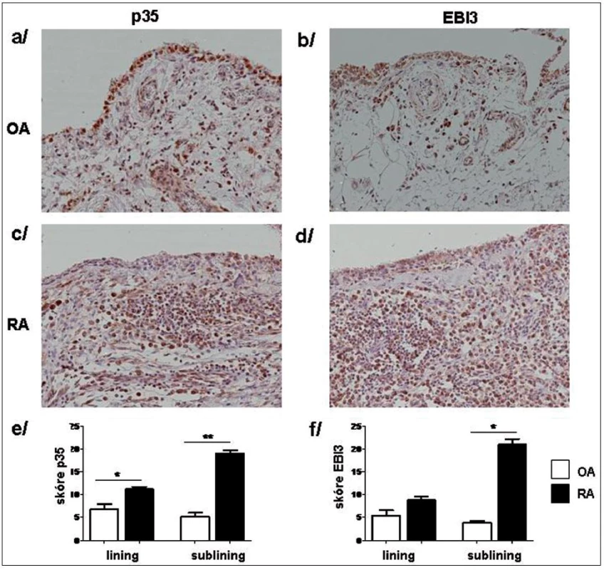 Imunonistochemické barvení p35 (a, c) a EBI3 (b, d) podjednotek IL-35 v OA (a, b) a RA (c, d) synoviální tkáni. Semikvantitativní hodnocení prokázalo vyšší expresi p35 (e) a EBI3 (f) jak v synoviální intimě (lining), tak v oblasti intersticia (sublining). Původní zvětšení x20. * p <0,05, ** p <0,01.
