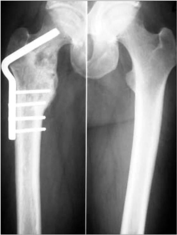 RTG snímky femorů, vpravo stav po osteosyntéze pro patologickou frakturu proximálního konce femoru, přetrvává osteolytické ložisko krčku femoru.
