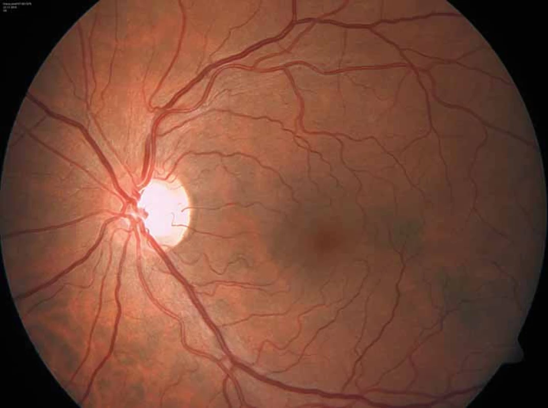 Charakteristicky vinuté retinální cévy u pacienta s Fabryho chorobou.
Fig. 7. Characteristic tortuous retinal vessels in a Fabry disease patient.