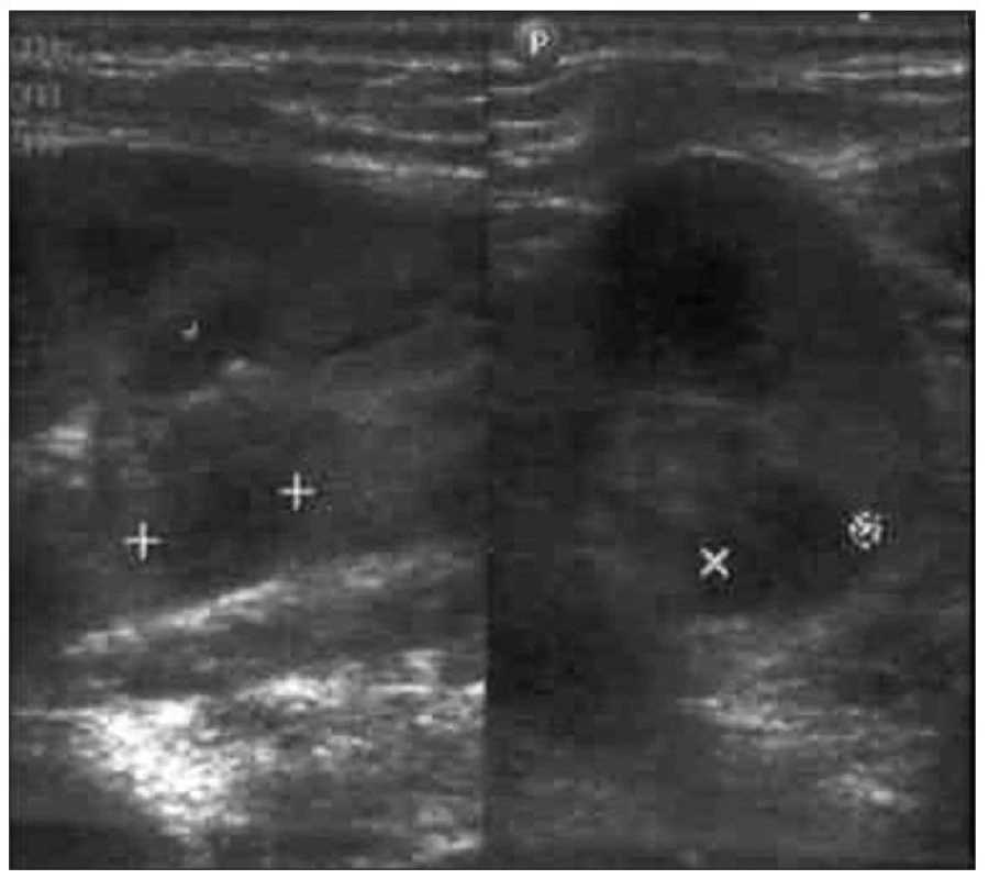 USG vyšetrenie pri prijatí: obraz početných hypoechogénnych ložísk bilaterálne.
Fig. 1. USG examination upon admission: a picture of numerous bilateral hypoechogenic foci.