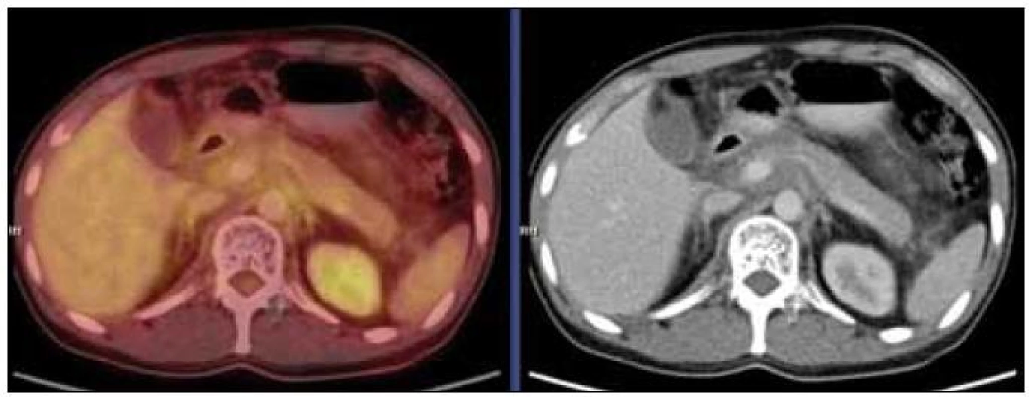 PET-CT vyšetření s podáním i.v. kontrastu provedené v září roku 2010. Mediastinem, jaterním hilem a kaudálněji celým retroperitonálním prostorem se spolu s cévami pruhovitě táhne „cárovitě“ hypodenzní (hemagiomatózní) infiltrát, jehož metabolická aktivita je srovnatelná s pozadím. Lze tedy říct, že ani kostní postižení, ani infiltrát v mediastinu, retroperitoneu nevykazoval patologickou míru konzumpce FDG, kterou běžně vídáme u většiny ložisek maligní etiologie.
