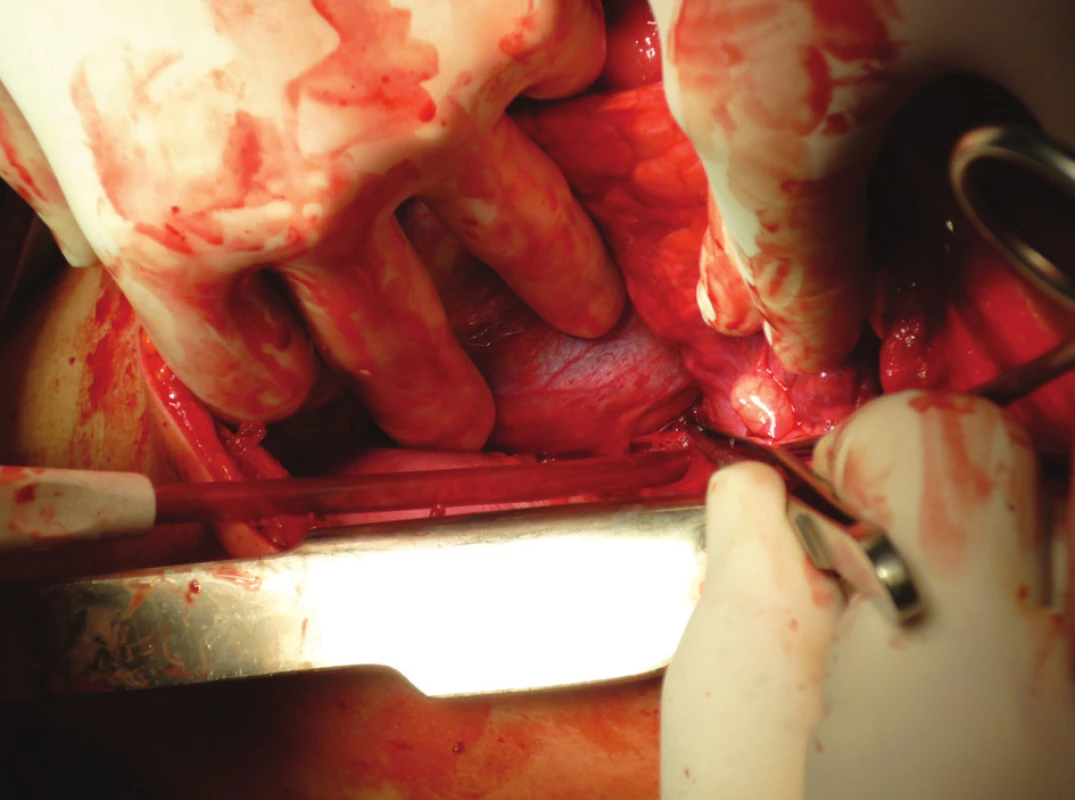 Perioperační nález perforace perikardu a pravé srdeční komory
Fig. 6. Perioperative finding of pericardial and right ventricular perforation