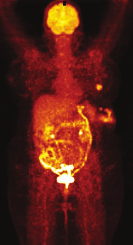 PET/CT Metastázy maligního melanomu v podkoží zad a levé axily
Fig. 5: PET/CT Malignant melanoma metastases to the subcutaneous tissue of the back and the left axilla