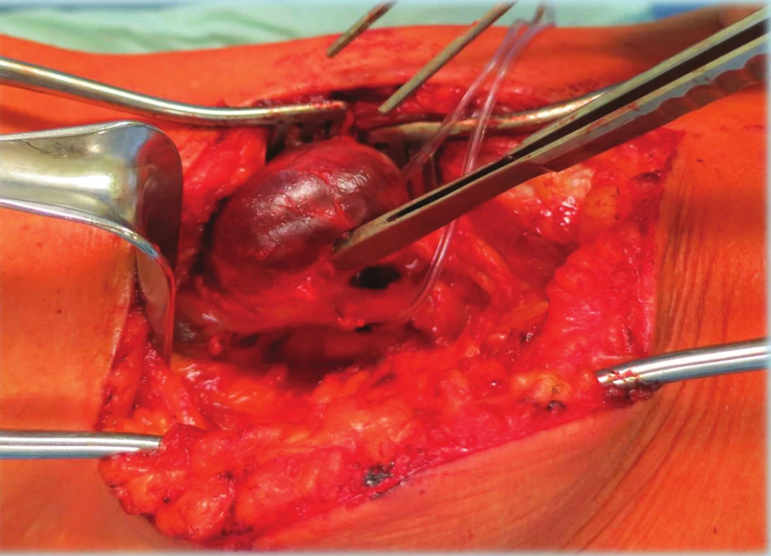 Vypreparované PVA
Fig. 3: Dissection of PVA