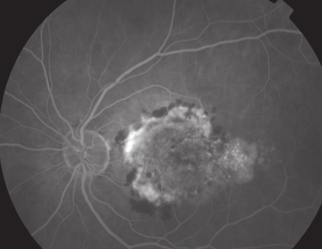 Fluorescenční angiogram – vlhká forma VPMD.