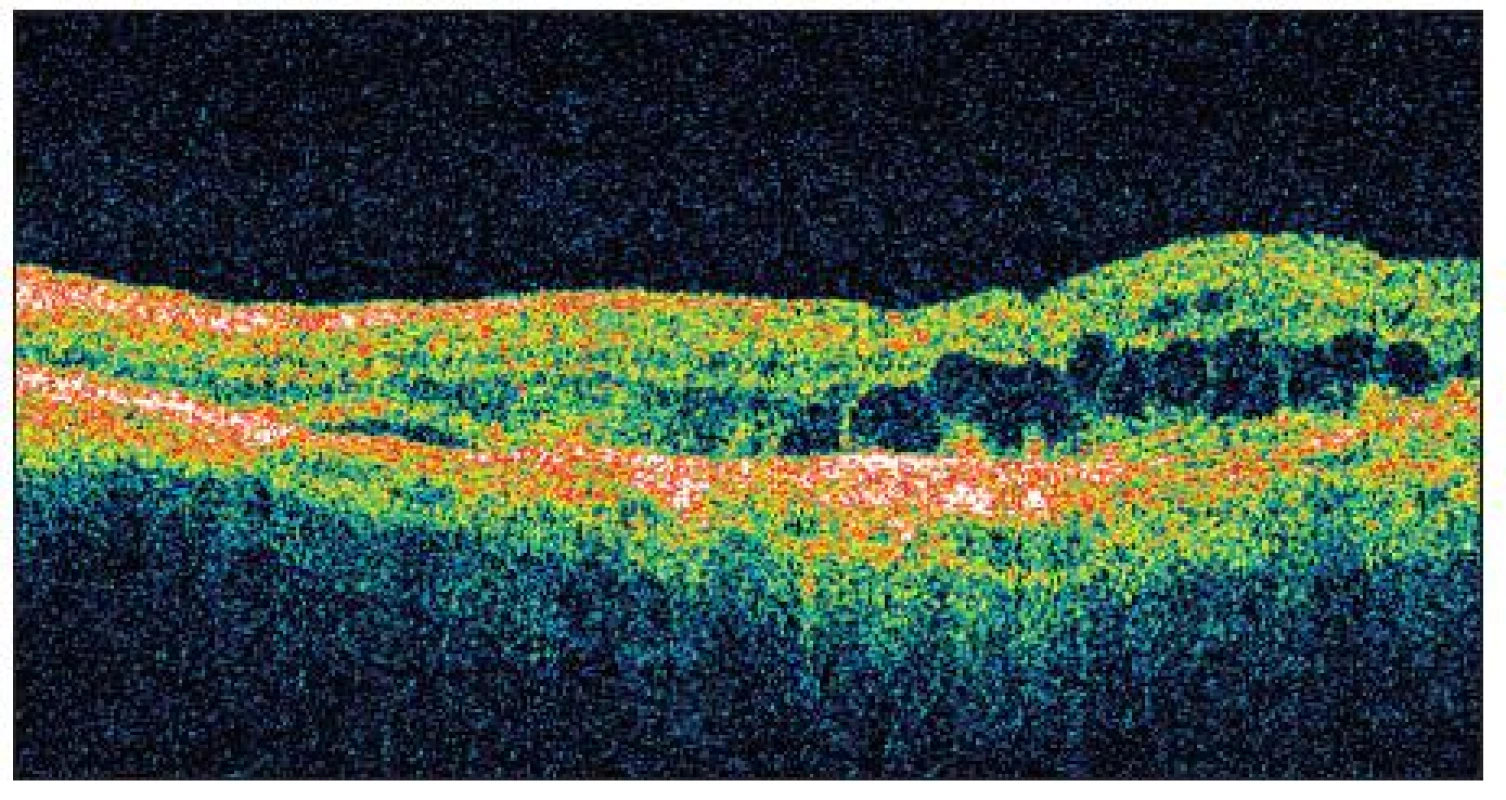 OCT OS prosinec 2009 tlouštka neuroretiny ve fovee: 380 μm