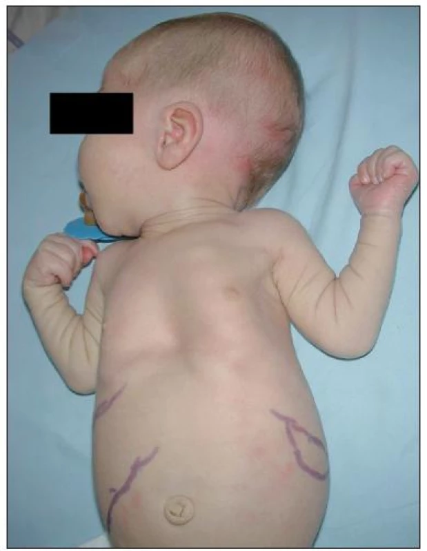 Hepatosplenomegalie a umbilikální hernie.
Fig. 2. Hepatosplenomegaly and umbilical hernia.