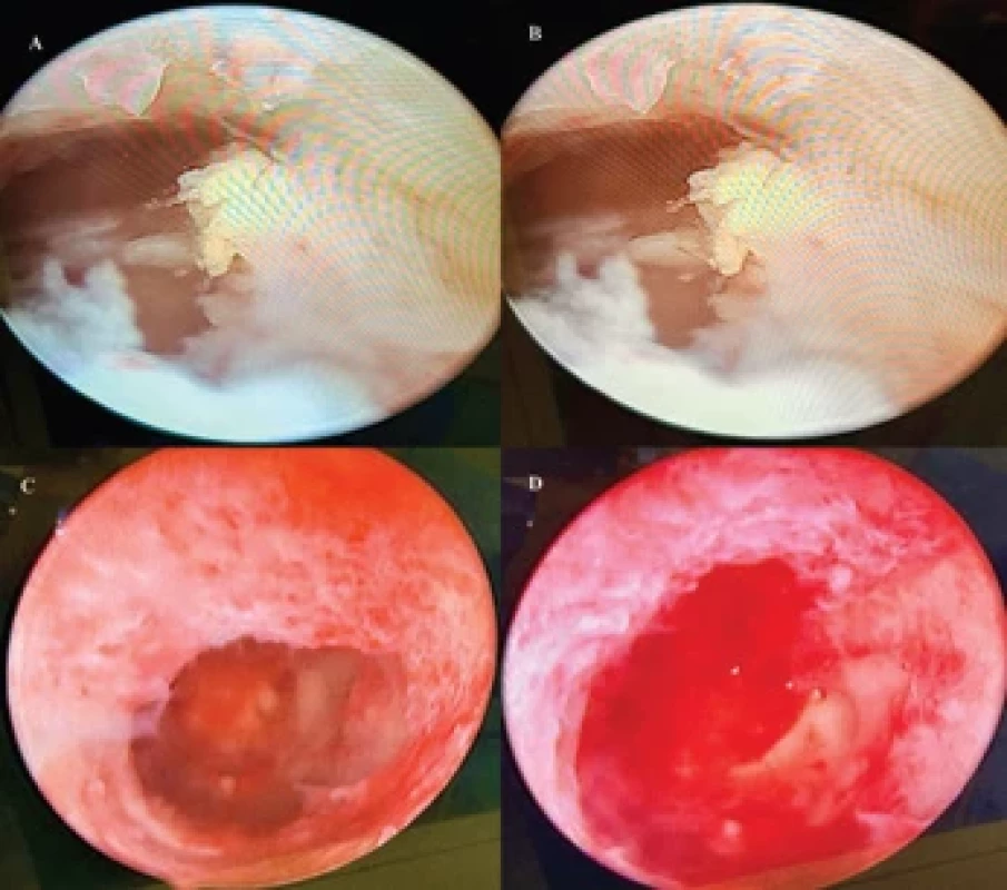 Hysteroscopy showed a uterine cavity with a smooth endometrial surface, reddish coloration, normal vascularization, and a proliferative appearance (A). A focal thickening was identifi ed near the left cornual uterine region (B), which was removed using forceps, resulting in a homogeneous endometrial cavity (C and D). Editor’s note: The optical eff ect observed in the image is a consequence of the method of its acquisition and does not aff ect the interpretation of the displayed information.