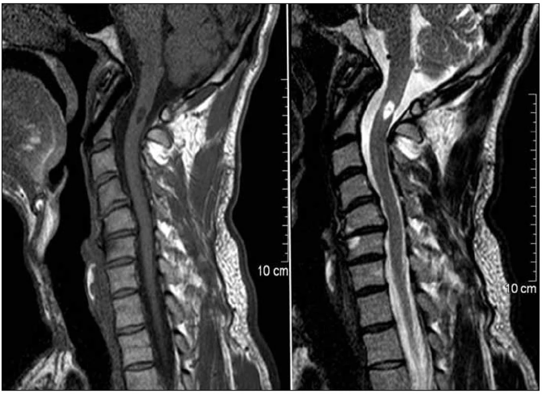 MR kontrola morfologického nálezu na horní krční míše v sekvencích T1 a T2 s odstupem 6 měsíců po stabilizaci. Intramedulární pseudocysta velikosti 5 × 10 mm je výsledkem úklidové reakce uvnitř nervové tkáně. Vzhledem k výslednému neurologickému stavu pacienta jde o překvapivý nález.