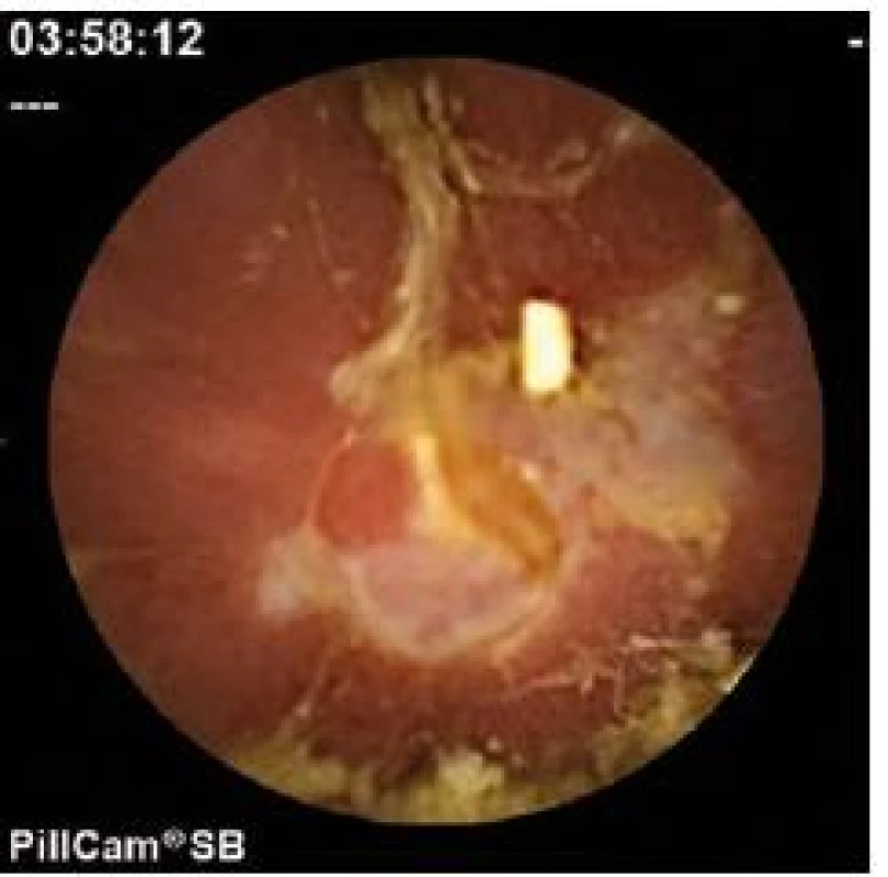 Diagnostický nález z vyšetrenia kapsulovou enteroskopiou.
Fig. 1. Conclusive finding using capsule enteroscopy.