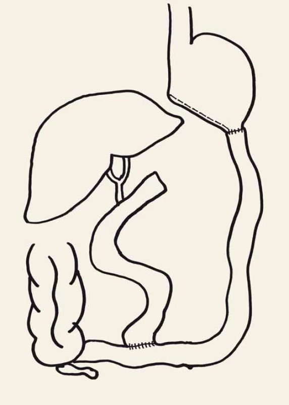 Biliopankreatická diverze.
Fig. 4. Biliopancreatic diversion.