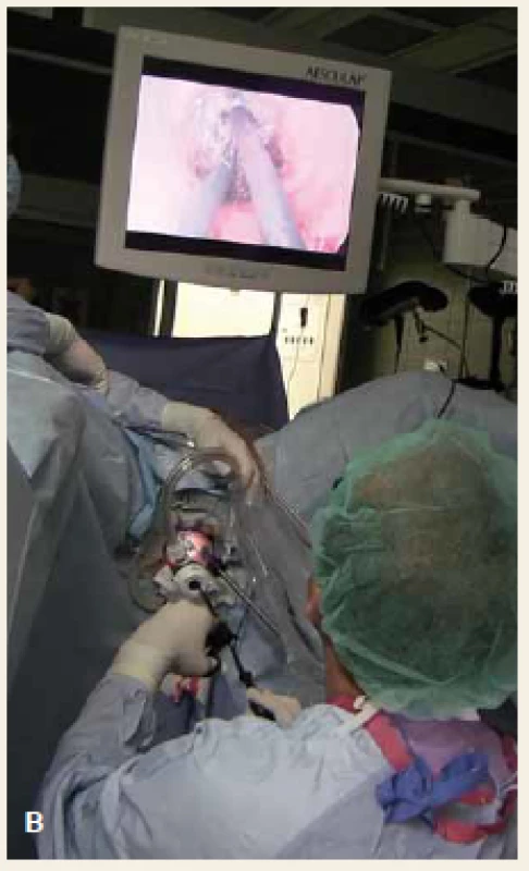 A. Detail na transanálně zavedený port, B. pozice operatéra během transanální fáze TAMIS.
Fig. 2. A. Detail of a transanally inserted port, B. surgeon position during the transanal phase of TAMIS procedure