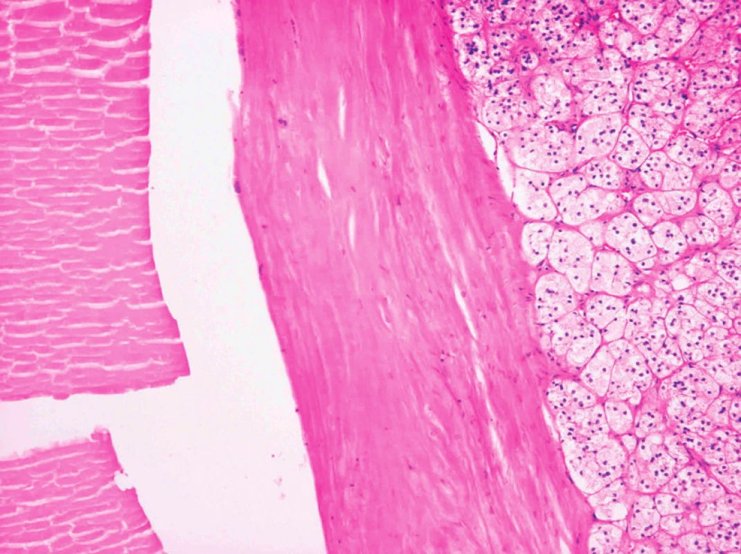 Stěna cysty vystlaná endotelem, 100× zvětšeno, barveni hematoxylin eosin, vpravo viditelná tkáň nadledviny
Fig. 4. Wall of the cyst lined by endothelial cells, 100× magnifi ed, hematoxylin eosin staining, adrenal gland tissue visible on the right
